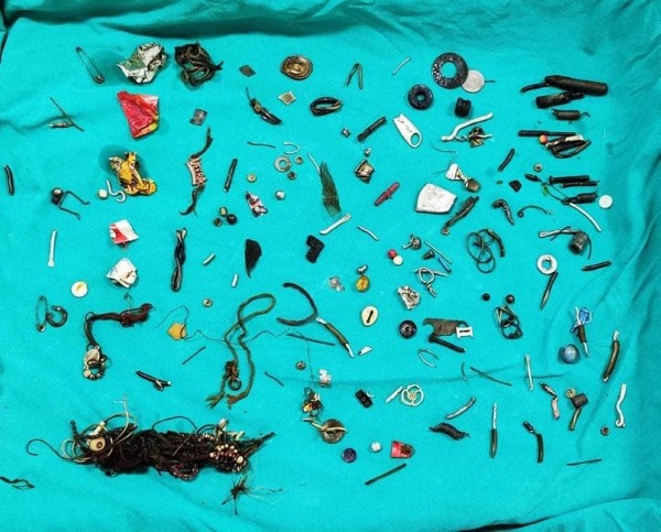 У мужчины два года непрерывно болел живот — рентгеновский снимок впечатлил медиков